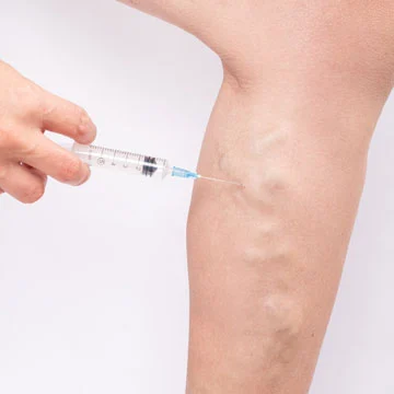Foam Sclerotherapy for Varicose Veins